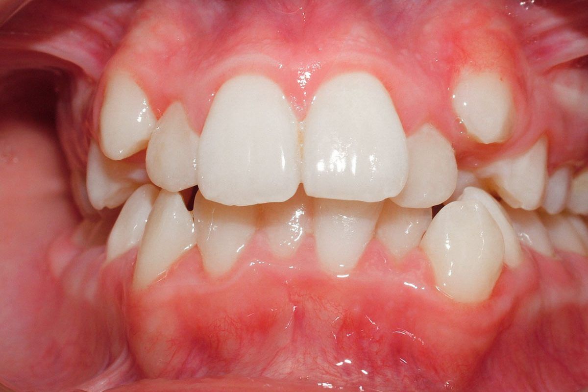 Tratamento Apinhamento Dentário